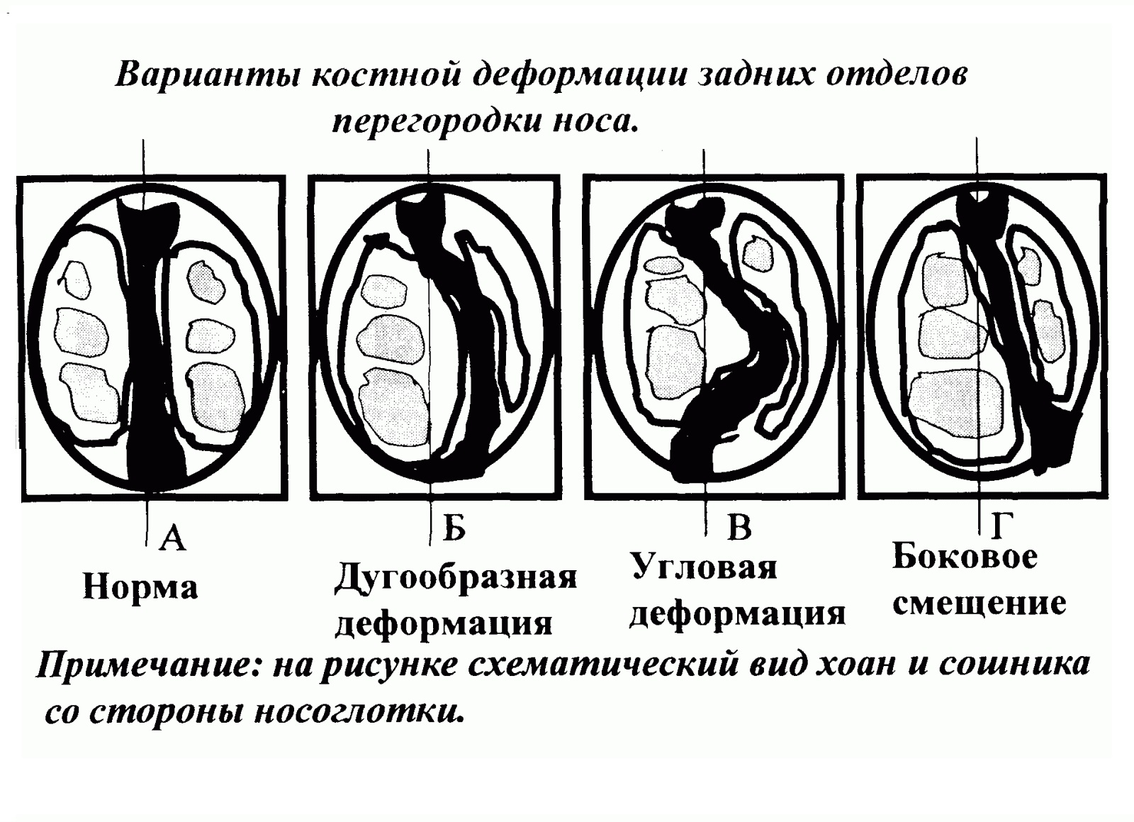 Искривление носовой перегородки. Типы искривления перегородки. Степени искривления носовой перегородки на кт. Искривление носовой перегородки классификация. Степени искривления носовой перегородки.